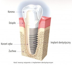 implantoprotetyka
