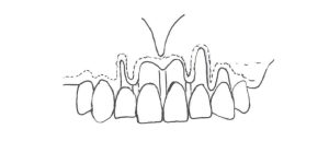 Poprawa zgryzu - zabieg periodontologiczny